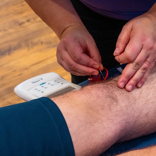 Acupuncture